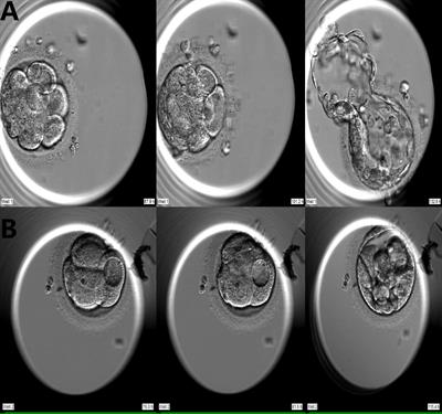 Vacuolization in embryos on days 3 and 4 of in vitro development: Association with stimulation protocols, embryo development, chromosomal status, pregnancy and neonatal outcomes